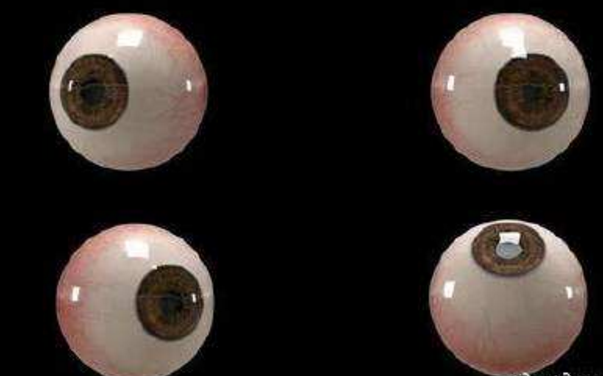世界首個(gè)3D人工眼球問(wèn)世，數百萬(wàn)人將重見(jiàn)光明
